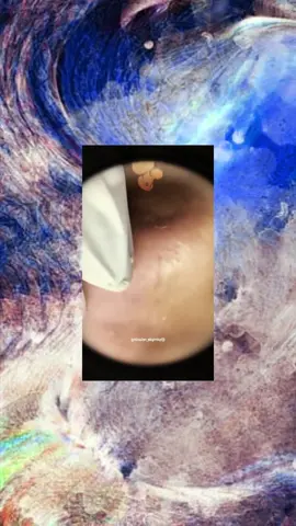#squeezeyuk #satysfying #pimple #foryou #relax