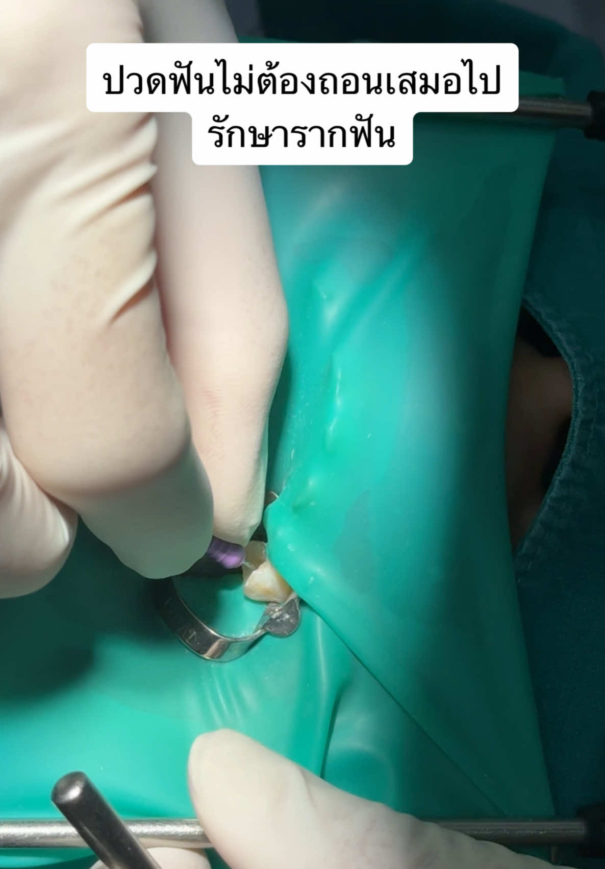 ปวดฟัน🦷ไม่ต้องถอนเสมอไป รักษารากฟัน #thedentrangsit #หมอพรพนิตเดอะเด้นท์ #รักษารากฟัน #ทีมหมอโชค 