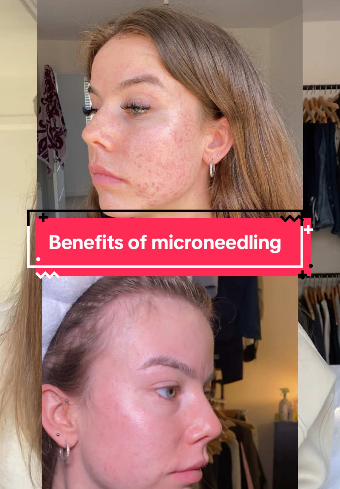 Benefits I’ve experienced from Microneedling #microneedling #acne #acnescars #microneedlingbeforeandafter  #creatorsearchinsights 