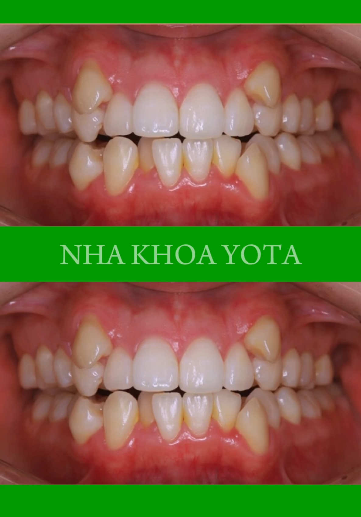 Niềng răng invisalign, niềng răng trong suốt.#nhakhoayota #niềngrăng # #nhổrăngkhôn #răngtrẻem #niengrang #rangsu #nhorangkhon #rangtreem #nhatkyniengrang #niengranginvisalign #niengrangmaccai   #nhakhoa #răng #răng_miệng  #nhakhoauytin #chinhnha #xuhuong #chinhnha #xh Địa chỉ Nha Khoa Hà Đông. Nha Khoa uy tín tại Hà Nội. Khám răng Hà Đông