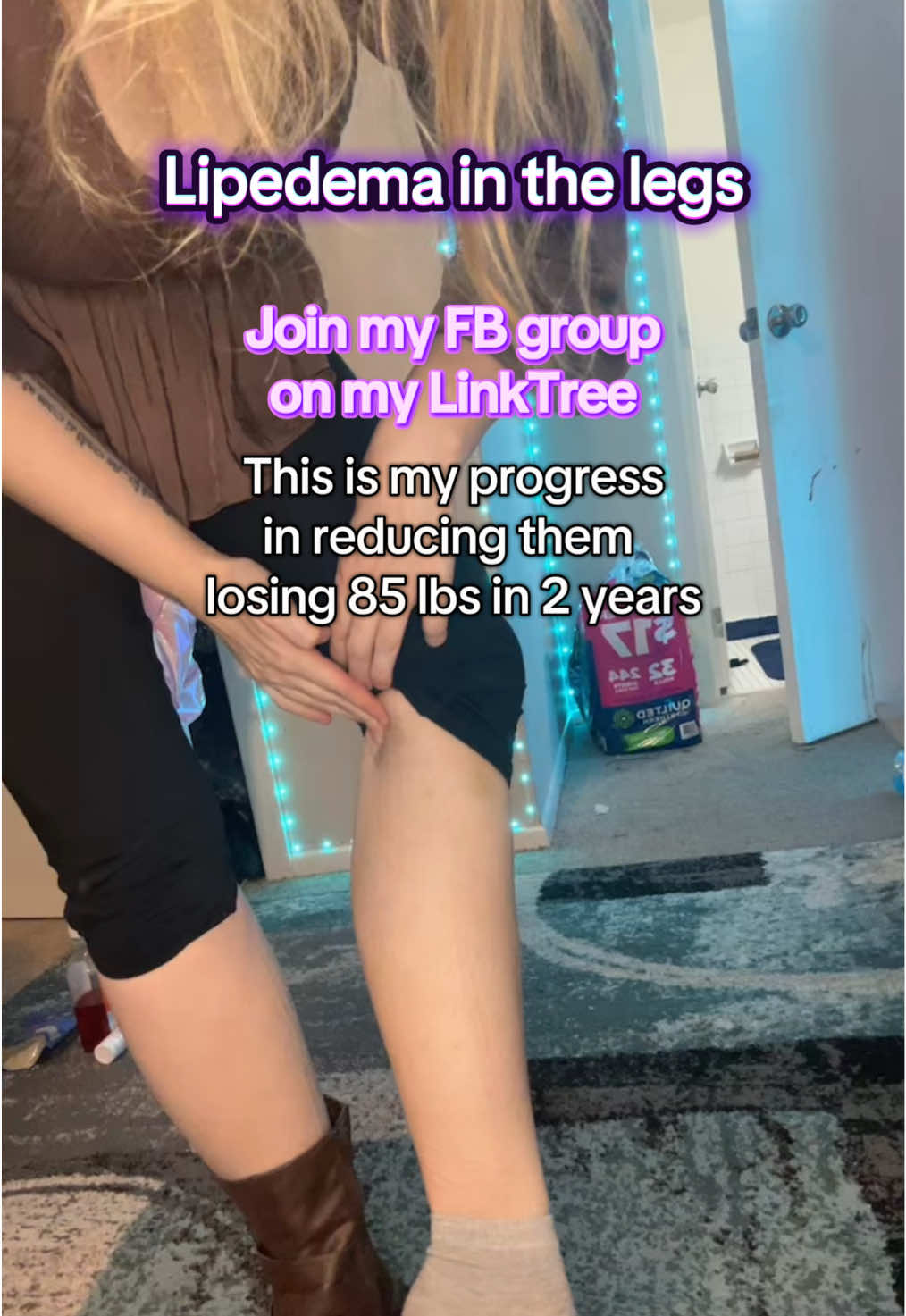 Reducing Lipedema Symptoms in the legs losing 85 lbs. join my FB group. #creatorsearchinsights #lipedema #lipedemalegs #weightloss #fatloss #lipoedema 