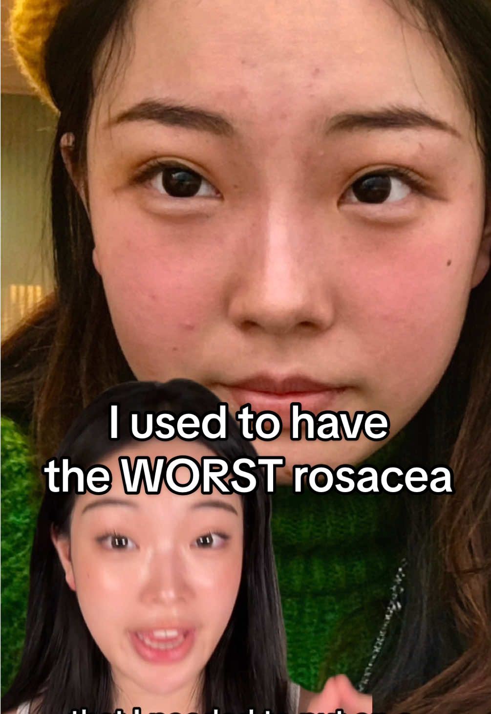 tips that helped me to get rid of rosacea! @Bloomkare  #koreanskincare #rosacea #bloomkarepartner #skincare #sensitiveskin #kbeauty #skinredness #moisturizer #dryskin #barrierrepair 