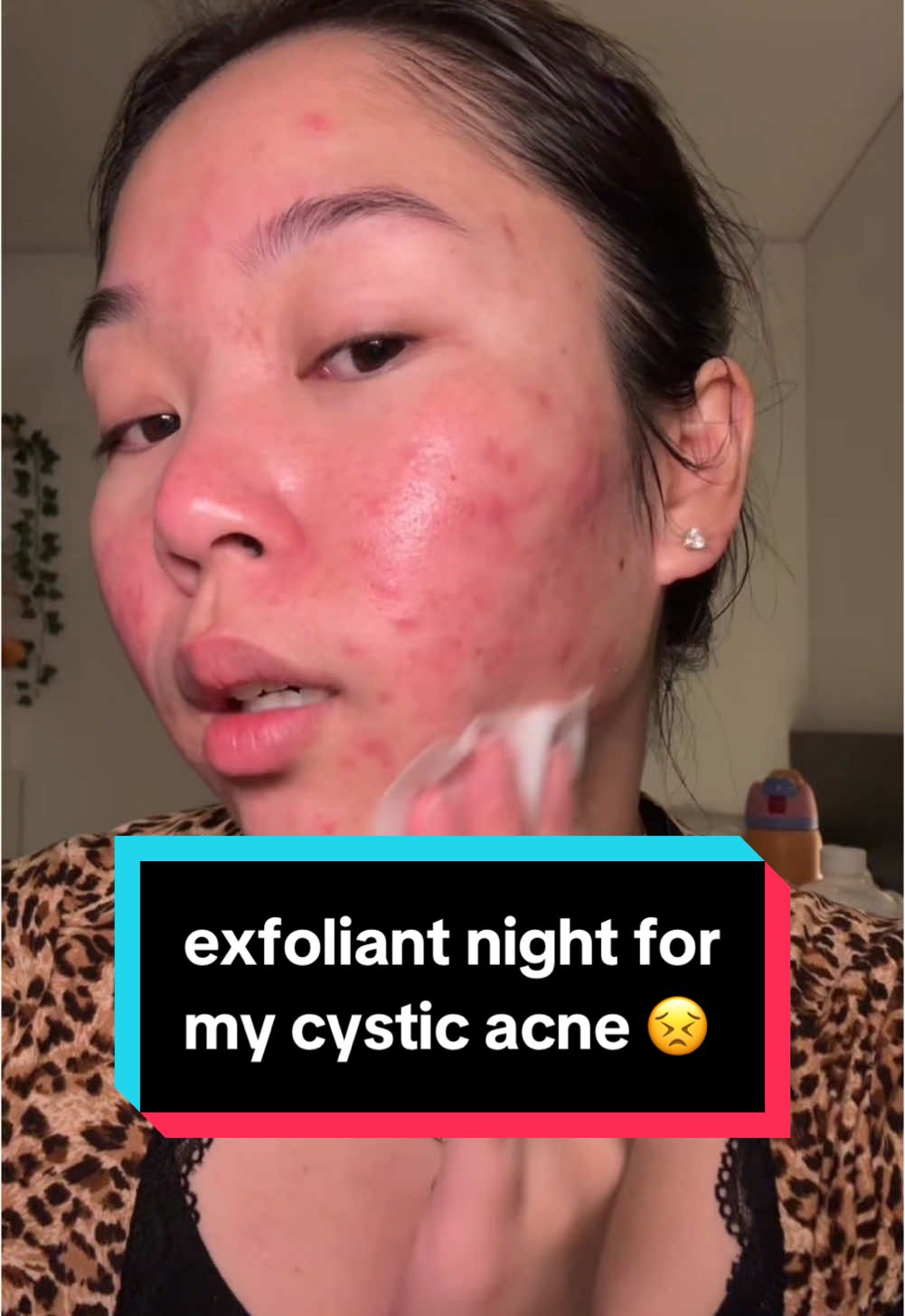 i need my skin to chill out fr 😩 #acne #cysticacne #skincare @Dr. Dennis Gross Skincare @PURITO SEOUL @Olehenriksen 