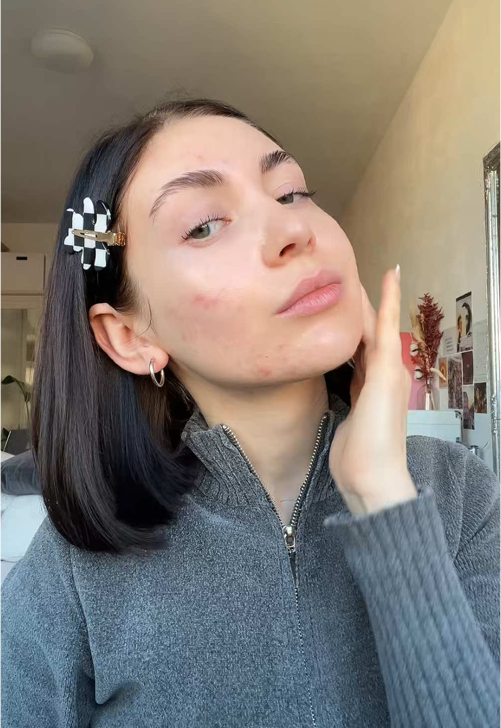 another acne video for everyone who struggling out there — you are not alone! 🫶🏻 my journey through the time, i was struggling wirh acne since 2022 makes me emotional everytime when i look at this pictures i was crying like every night and being so depressed, and emotional unstable. you are not alone, IT GETS BETTER!!!! 🤍 #acne #acneskin #acnetransformation #skintransformation #acnescars #acneawareness #akne #accutanejourney #accutane #MentalHealth 