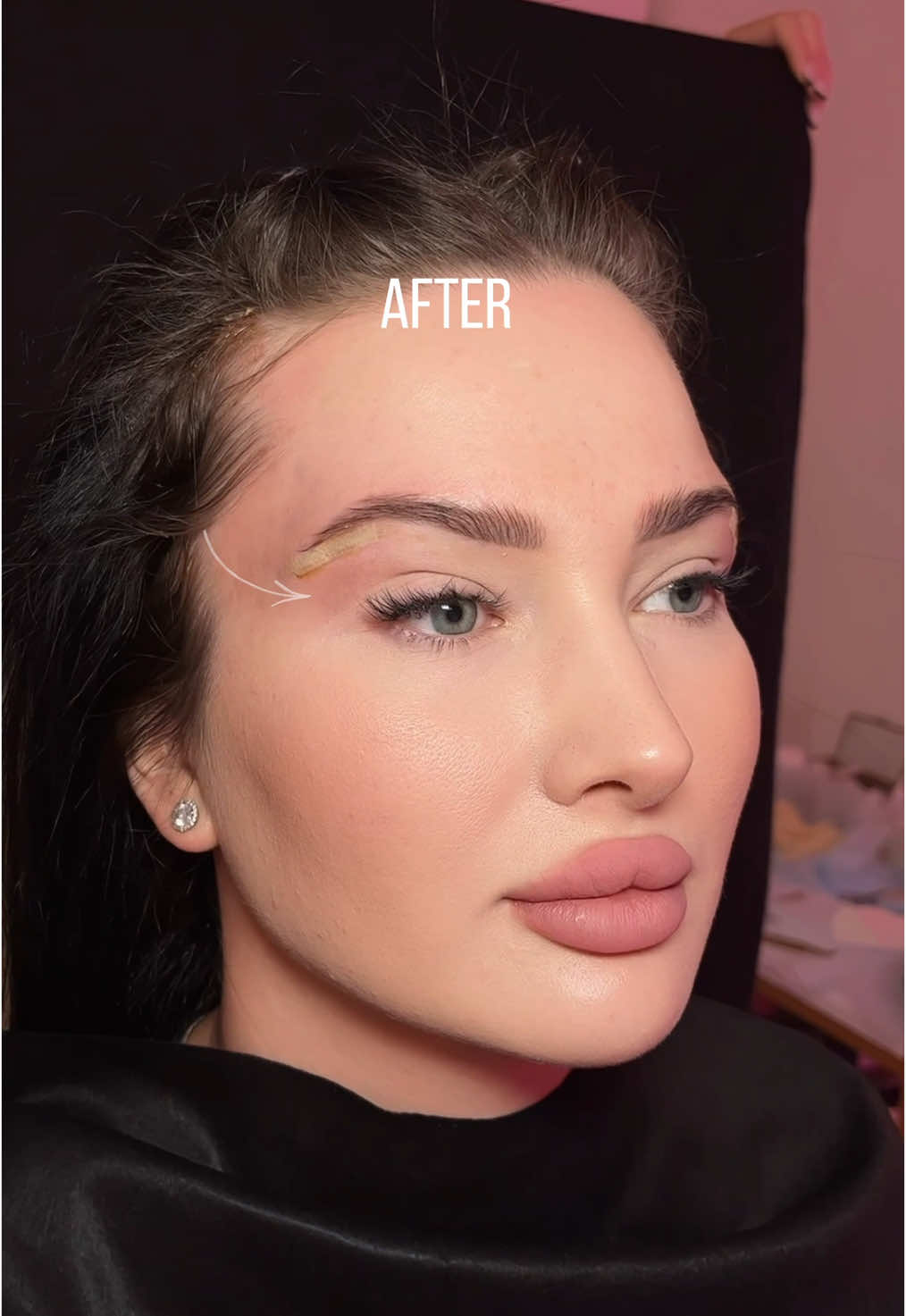 Fox eyes with threads 🪡  is a procedure which uses dissolvable threads to lift and elongate the eye to create a more almond shape, whilst simultaneously lifting the brow tail Before or After? 📍Moscow | Dubai | London appointments Schedule an appointment with one of our talented aesthetic doctors 👉 Sign up now: www.LFK-academy.com #recommendations #cosmetology #skincare  #fyp #fashion #estetik #lipfiller #jawline #fullface #botox #lifting #beauty#увеличениегуб #увеличениегубмосква #fullface #fullfaceмосква #fullfaceuk #lipfillersessex #lipaugumentation #коррекцияскул #lipfilleruk #коррекцияугловмосква #коррекцияскулмосква #лицоподключ #lipsaugmentationlondon #cheeksaugmentationlondon #russianlipstechnique #russianlips #russianlipstraining #lipsforkiss