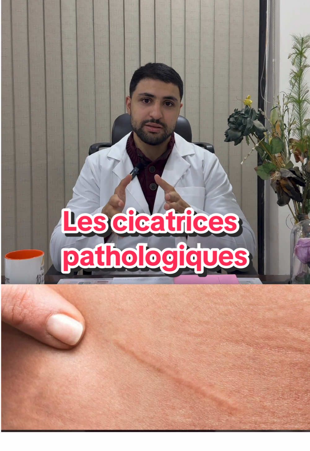 Cicatrices partie 2 مختلف أشكال الندبات  Les différentes formes cliniques des cicatrices  #ندبات #جلد  #cicatrices #chéloïdes #peau #dermatologie #santé 