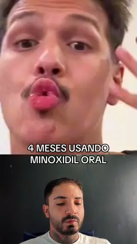 Achei o vídeo do @Rogério Araújo e quis trazer pra vocês verem que é possível sim o #tratamentocapilar contra a #calvicie com o #minoxidil  Aliás, tá muito bom teu resultado!! Que continuemos assim, criando #cabelo 😂🫶🏽