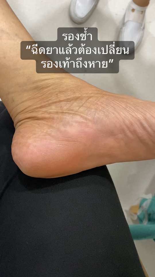 รองช้ำ “ฉีดยาแล้วต้องเปลี่ยนรองเท้าถึงหาย” ฉีดไปใช้เหมือนเดิม เป็นเหมือนเดิม #รองช้ํา #สเตียรอยด์ #ไม่หาย #ด็อกเตอร์หมอหมี 