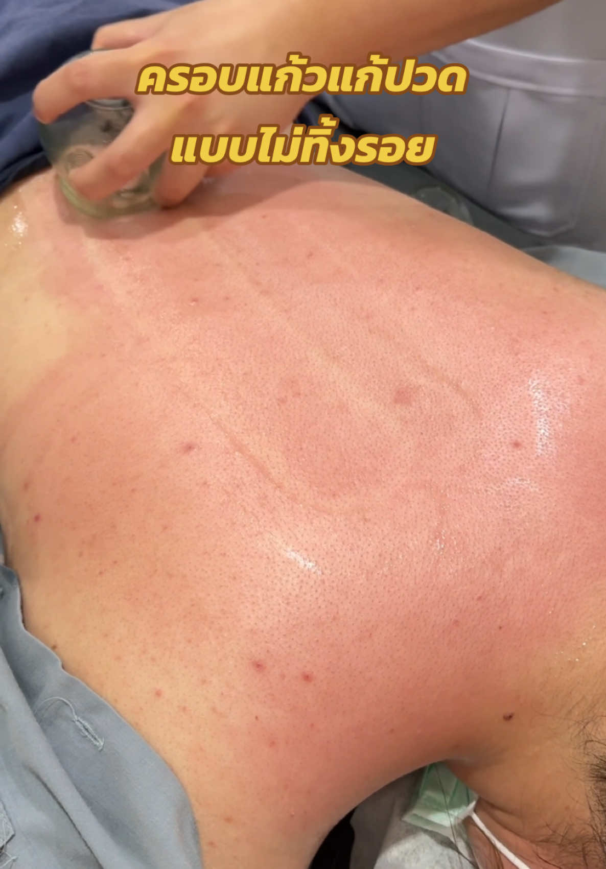 อยากครอบแก้ว แต่กลัวหลังเป็นรอย ก็สามารถแจ้งคุณหมอได้นะคะ คุณหมอสามารถครอบแก้วแบบไม่ทิ้งรอยให้ได้ค่ะ  #ออฟฟิศซินโดรม #ปวดคอบ่าไหล่ #ปวดสะโพกร้าวลงขา #ครอบแก้ว #ครอบแก้วรักษาอาการปวด #ครอบแก้วอ่อนนุช #cupping #cuppingtherapy #ฟาจินคลินิก 
