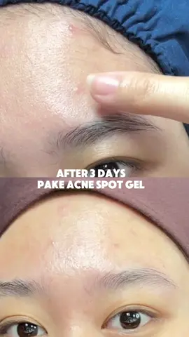 sukaaa banget acne spot gel dari @Reglow by Shindy Putri 