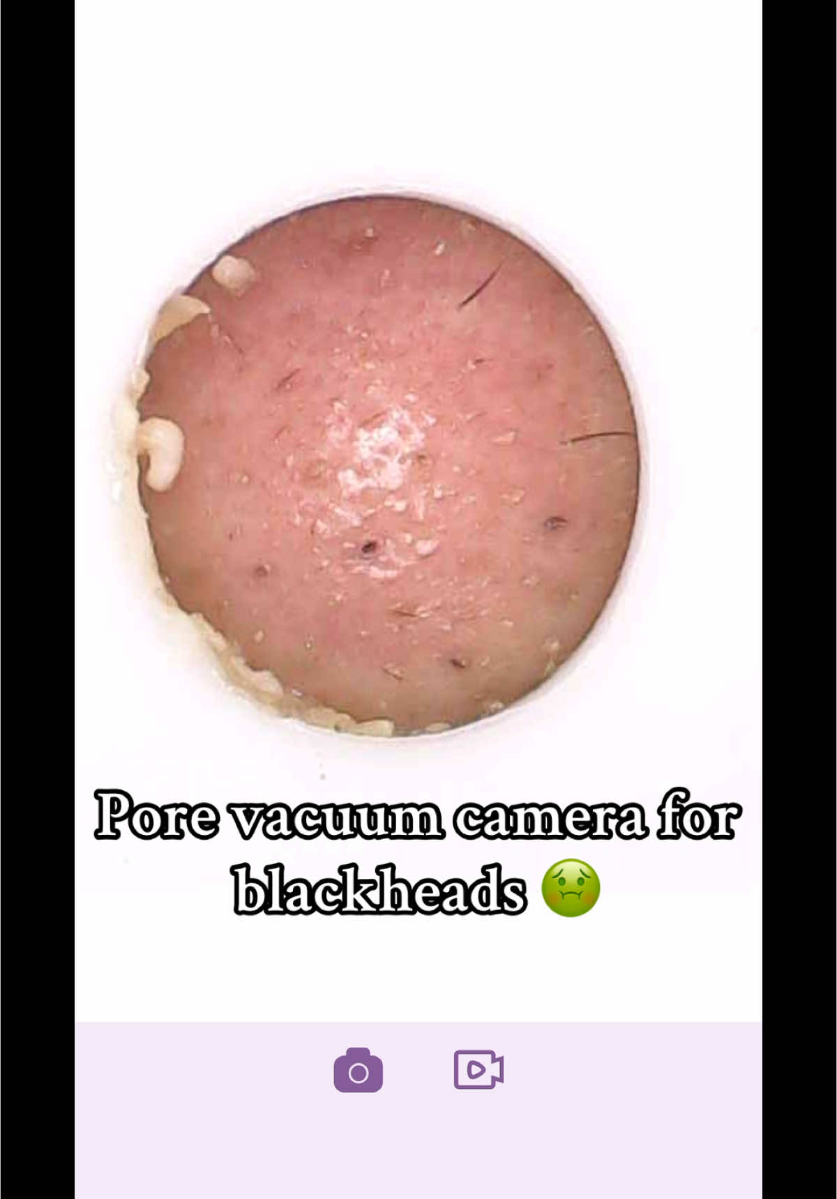 This pore vacuum is gross but so satisfying! #blackhead #blackheadextraction #blackheadremover #pimple #pimplepopper 