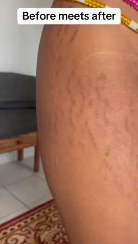 Besties are your stretchmarks still making you insecure? Then book an appointment with us. #stretchmarks #stretchmarkremoval #stretchmarksolution #tiktokcameroon🇨🇲tiktokafrica #skincare 