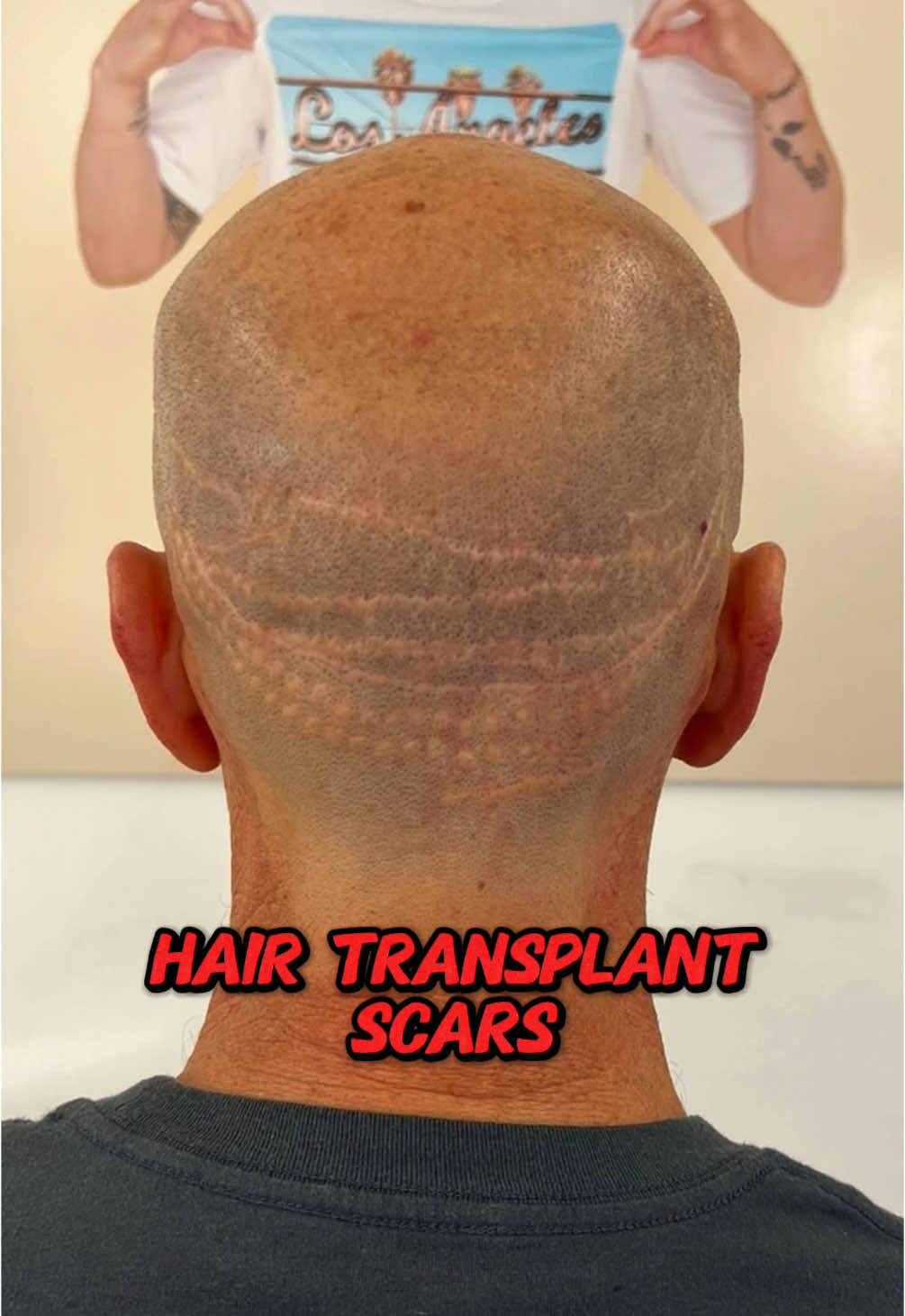 Multiple failed hair transplants left him with scars on the back of his head. We had to help him out using our scar camouflage treatment 🔥🙏 #scalpmicropigmentation #scalptattoo #hairtattoo #fyp #scar #scarfix #hairtransplantsurgery #hairtransplant #hairtransplantturkey 