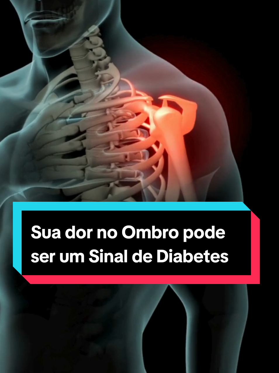 Sua dor no Ombro pode ser um sinal de diabetes. #ombro #ombrocongelado #dor 