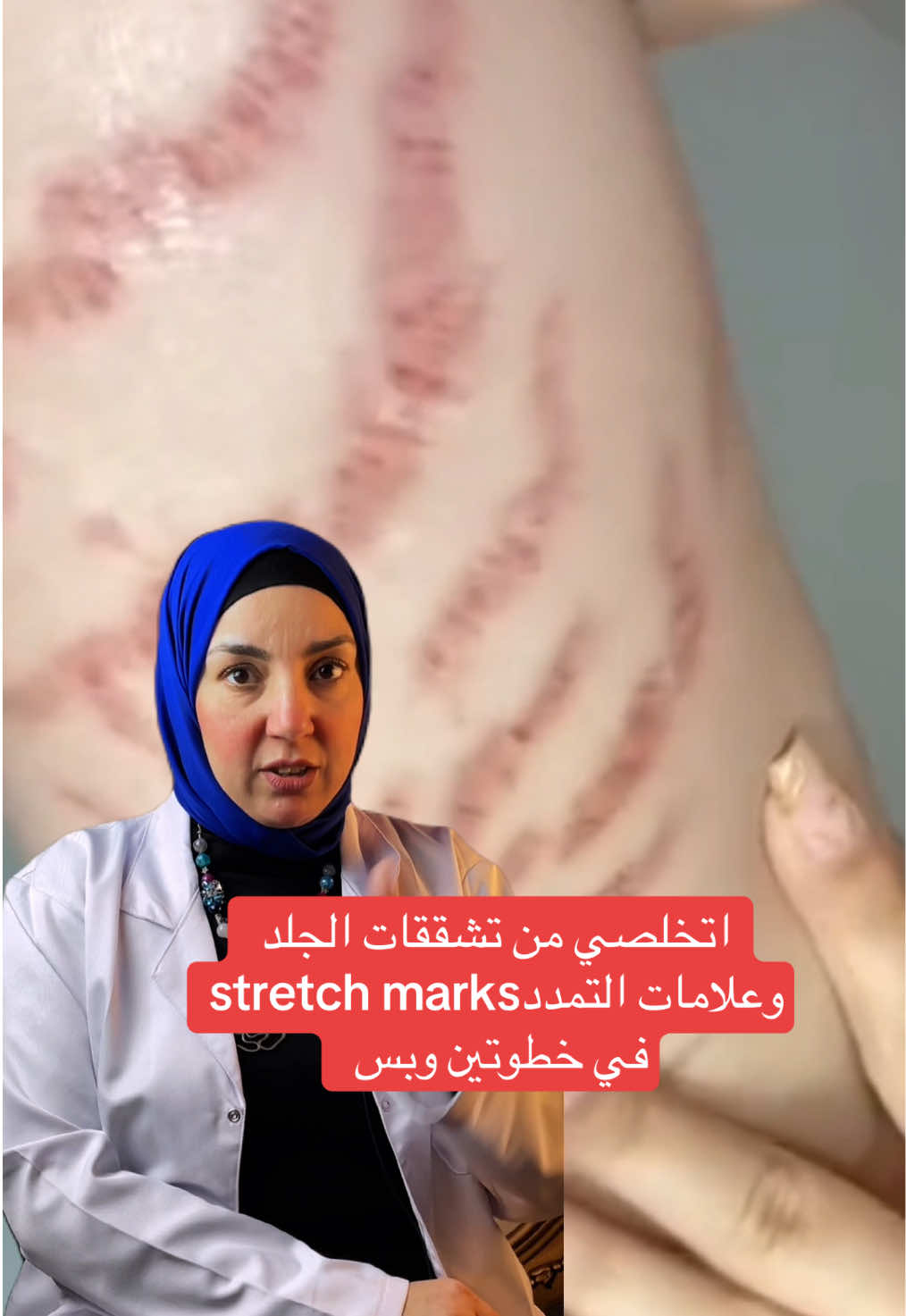 اتخلصي من تشققات الجلد وعلامات التمدد stretch marks في خطوتين بس والنتايج مبهرة  هنستخدم الديرما رولر ولوشن اسمه ڤيڤابودي ميلك  @vivainternationalpharma  #تشققات_الجلد #علامات_التمدد #stretch_marks #ترطيب_الجسم #ترطيب_البشرة #bodycareroutine  #bodycareproducts