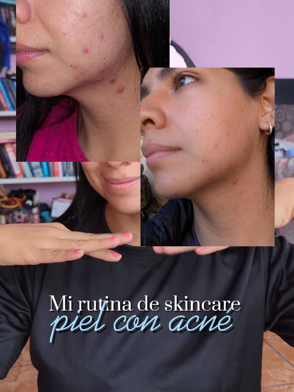 Rutina de skincare que me quitó los granitos en UNA SEMANA ✨ #skincare #skintok #skincareviral #SkinCare101 #acneskin #acnefighter #acneskincare #skincarecoreano #pielgrasa #pielsana 