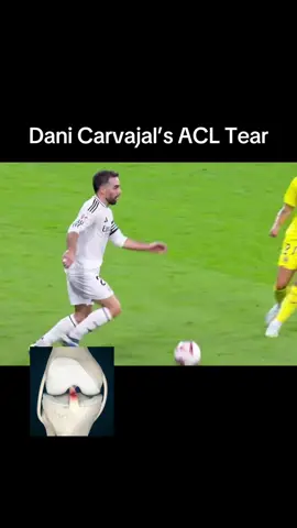 January 31, 2025, Dani Carvajal is in the midst of his recovery from a severe knee injury sustained in October 2024. He has expressed optimism about his rehabilitation, stating, “No tengo ninguna duda de que volveré a mi prime” (“I have no doubt that I will return to my prime”).