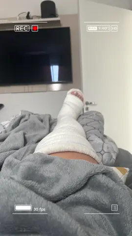Começando 2025 com o pé esquerdo, porque o direito foi de arrasta 😅.  #tibia #fibula #fratura #acidentedemoto #gesso 