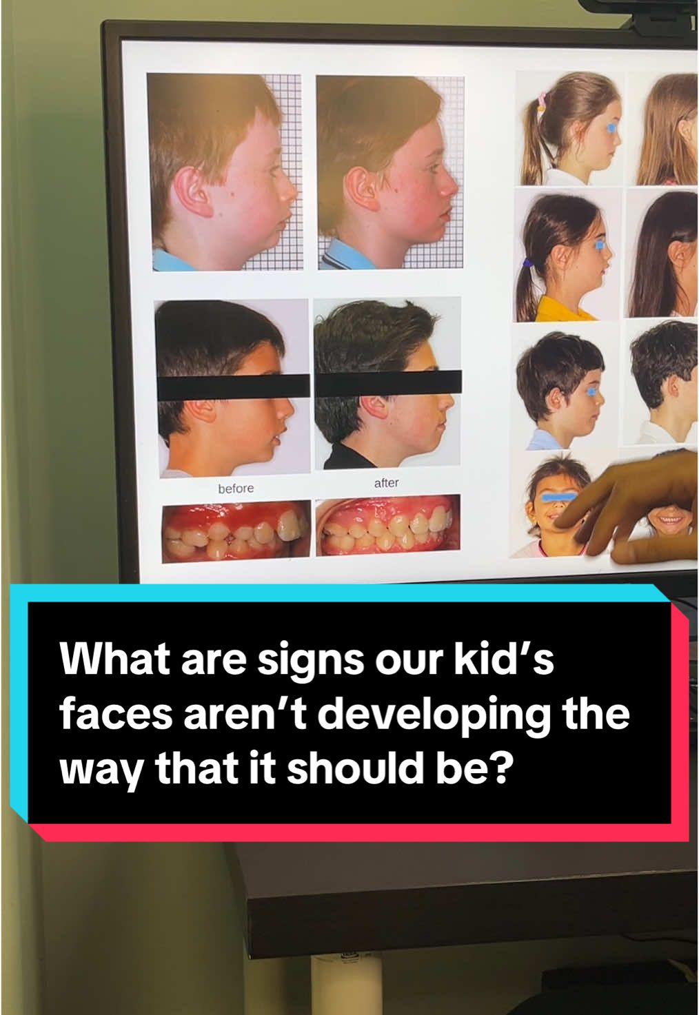 Beauty potential: What are signs our kid’s faces aren’t developing the way that it should be? #facialdevelopment #facedevelopment #jawdevelopment #weakjawline #MomsofTikTok #beauty 