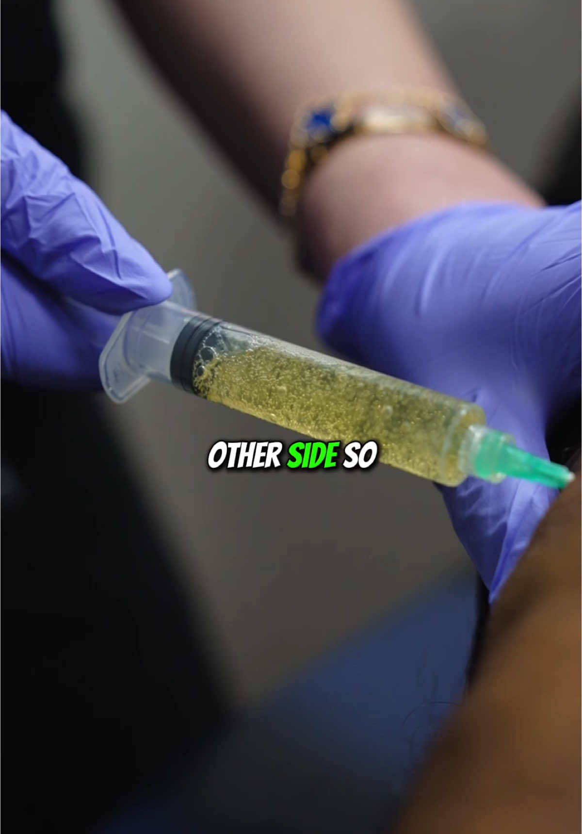 How to alleviate knee pain? Sometimes a steroid injection alone isn’t enough for knee pain relief—especially when excess fluid is present. 💉🦵 In these cases, knee aspiration is performed first to remove the fluid, followed by a steroid injection for better absorption and effectiveness. A targeted approach for lasting relief! ✨  #painmanagement #kneepain #arthritis 