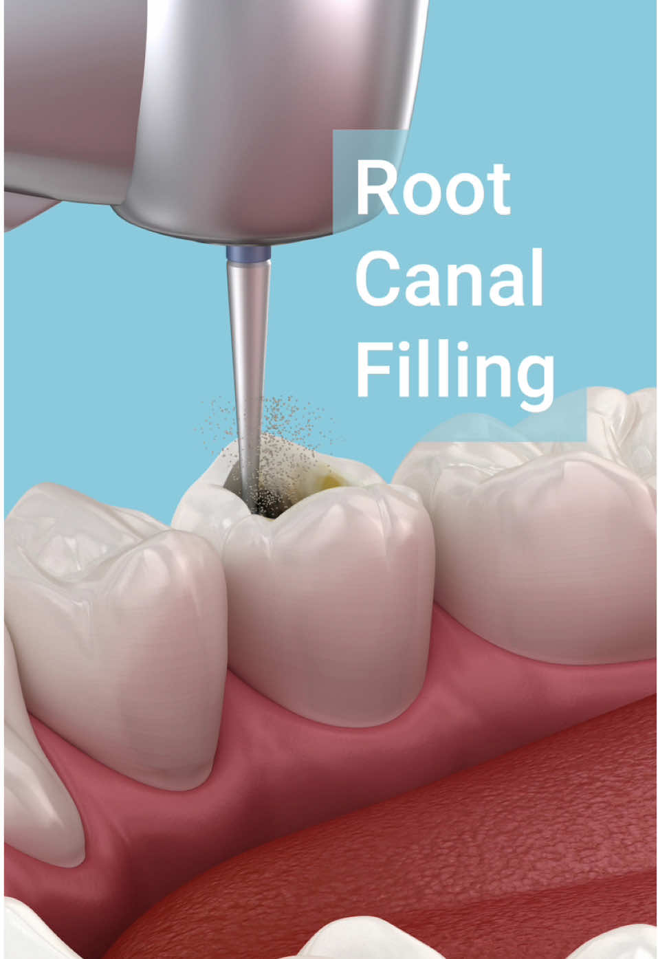 Dental root canal filling process. 3D Animation of procedure of caries removing and  tooth's root canal cleaning and filling to prevent bacteria and other contaminants from entering inside #dental #dentalanimation #caries #endo #endodontic #dentist #teeth #tooth #dentalclinic #dentalstudent #dentalschool #dentalvideo 