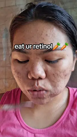 Eat your retinol! Beta-carotene from carrots🥕 = skin-loving vitamin A. Nourish from the inside out! #EatYourSkincare #RetinolFromWithin #fypage #AcneProne #skincareroutine #HealingJourney 