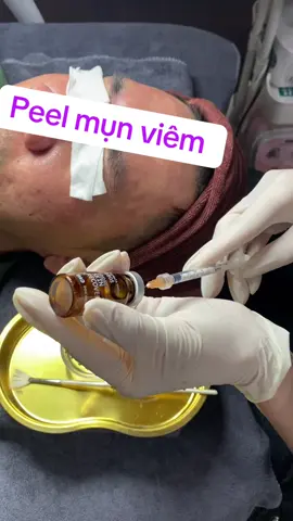 Peel mụn viêm#inno #peel #xuhuong #thinhhanh #skincare #mun #trangda 