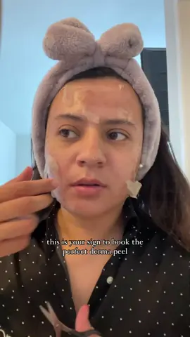 This is how you properly take off peeling skin after your Perfect Derma Peel treatment! IG: @secretskinbar #theperfectdermapeel #skincare #skincareroutine #peel  #acne #beforeandafterskin 