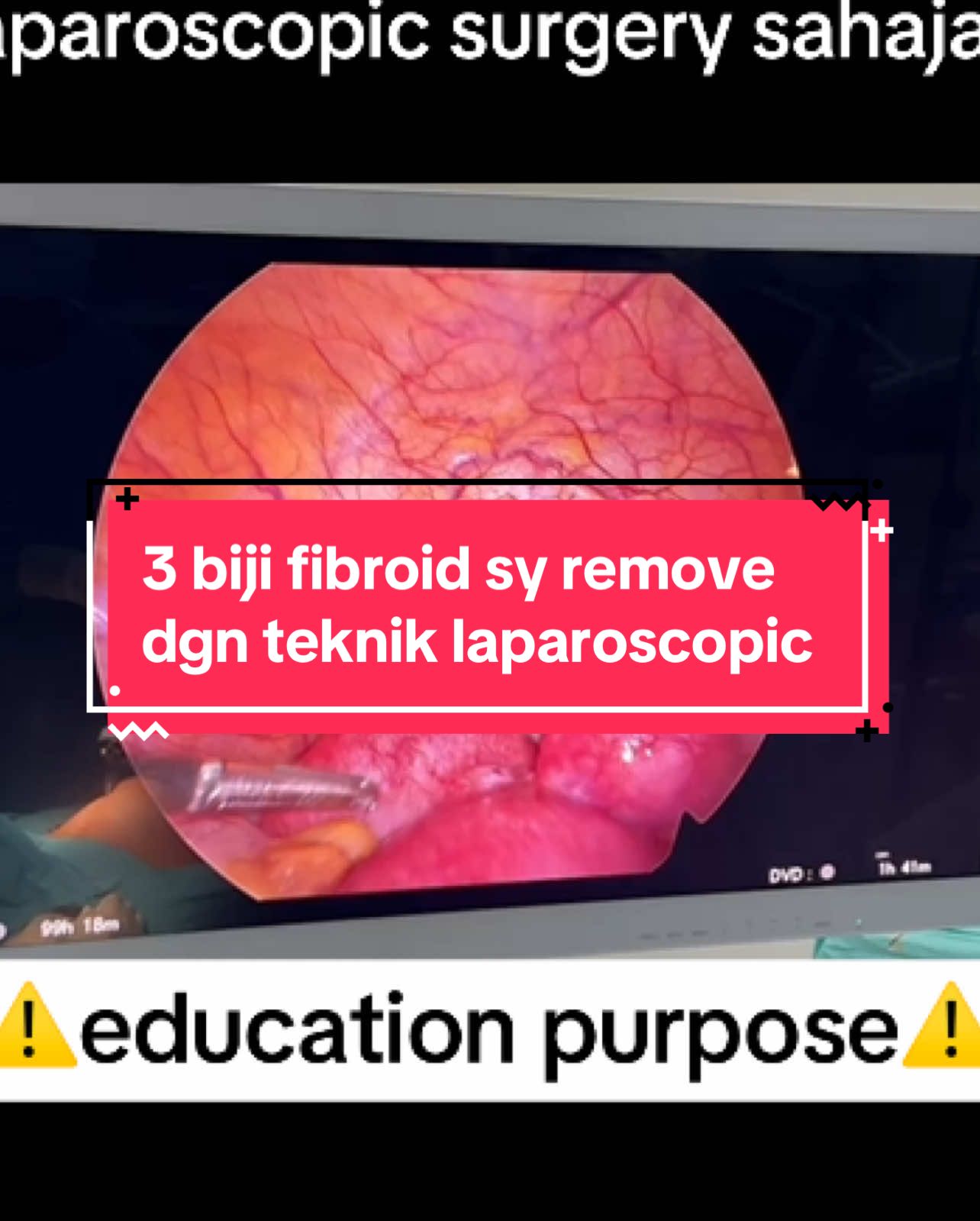 Nanti sy share ada lg fibroid yg besar dan banyak.  #klinikdryati #pantaihospitalsungaipetani #dryati #makbidan #educationalpurposes #drpakarsakitpuan 