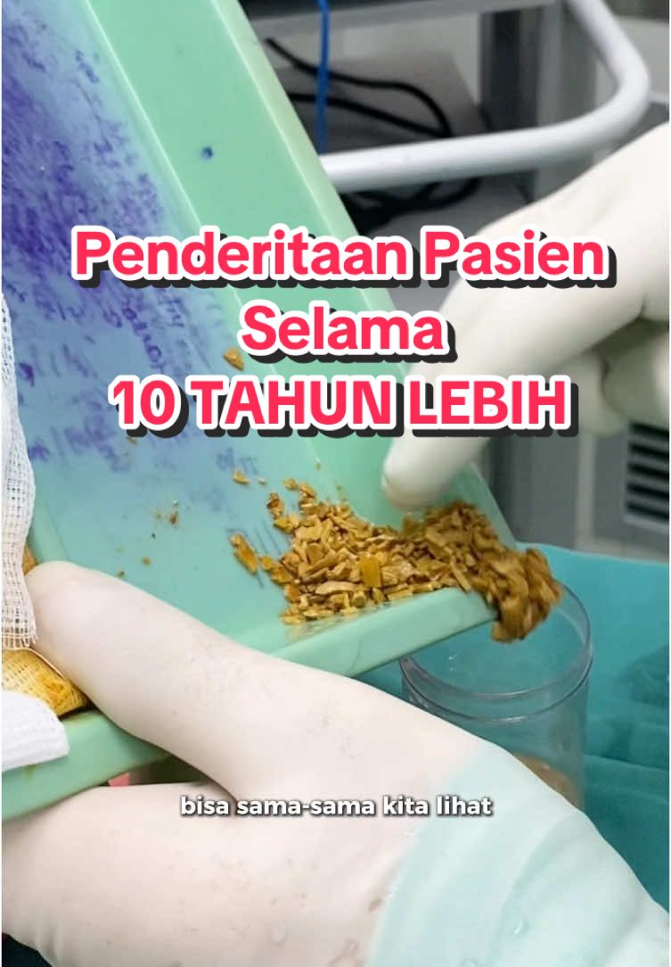 Bahaya batu kandung kemih jika dibiarkan makin lama hanya akan memperburuk keadaan, batu makin membesar & resiko komplikasi #edukasikesehatan 