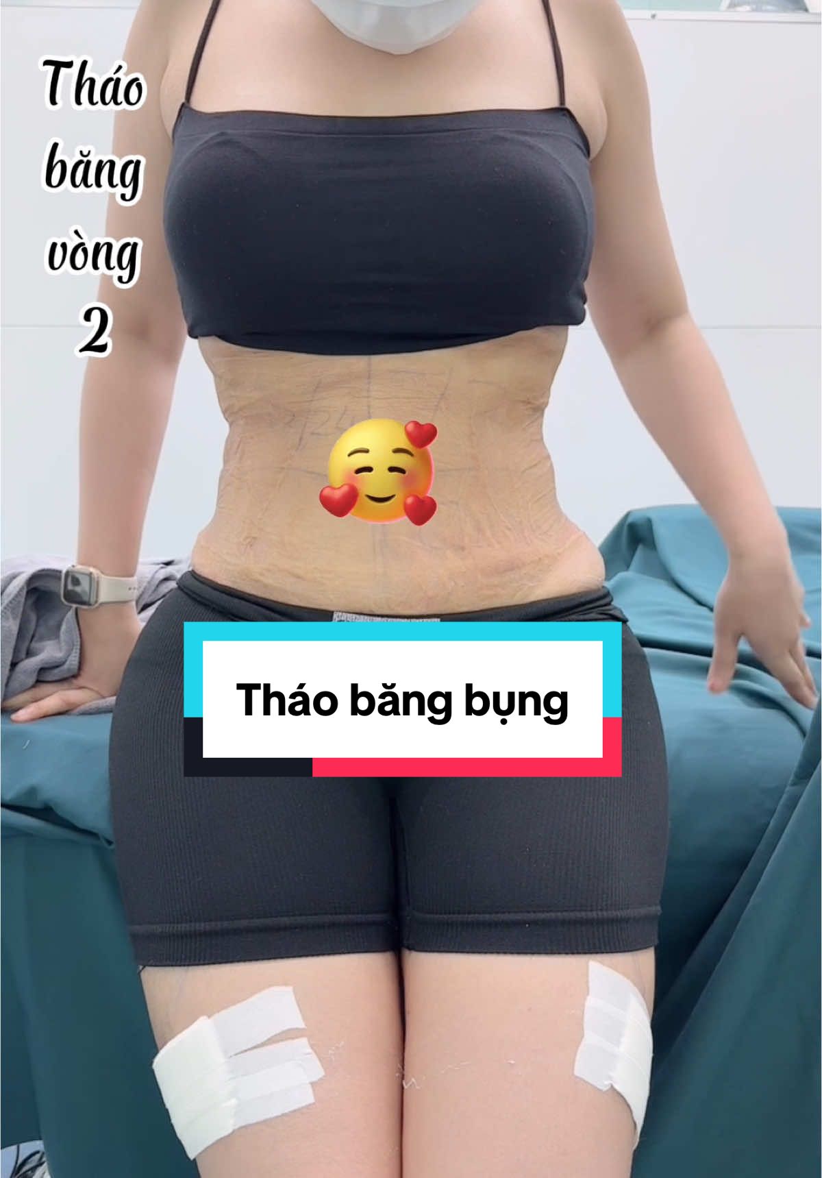 Tháo băng bụng😊#CapCut #phongbeauty #thinhhanh #xuhuong #lamdepantoan #phauthuatthammy #hutmo #indonesia #viral 