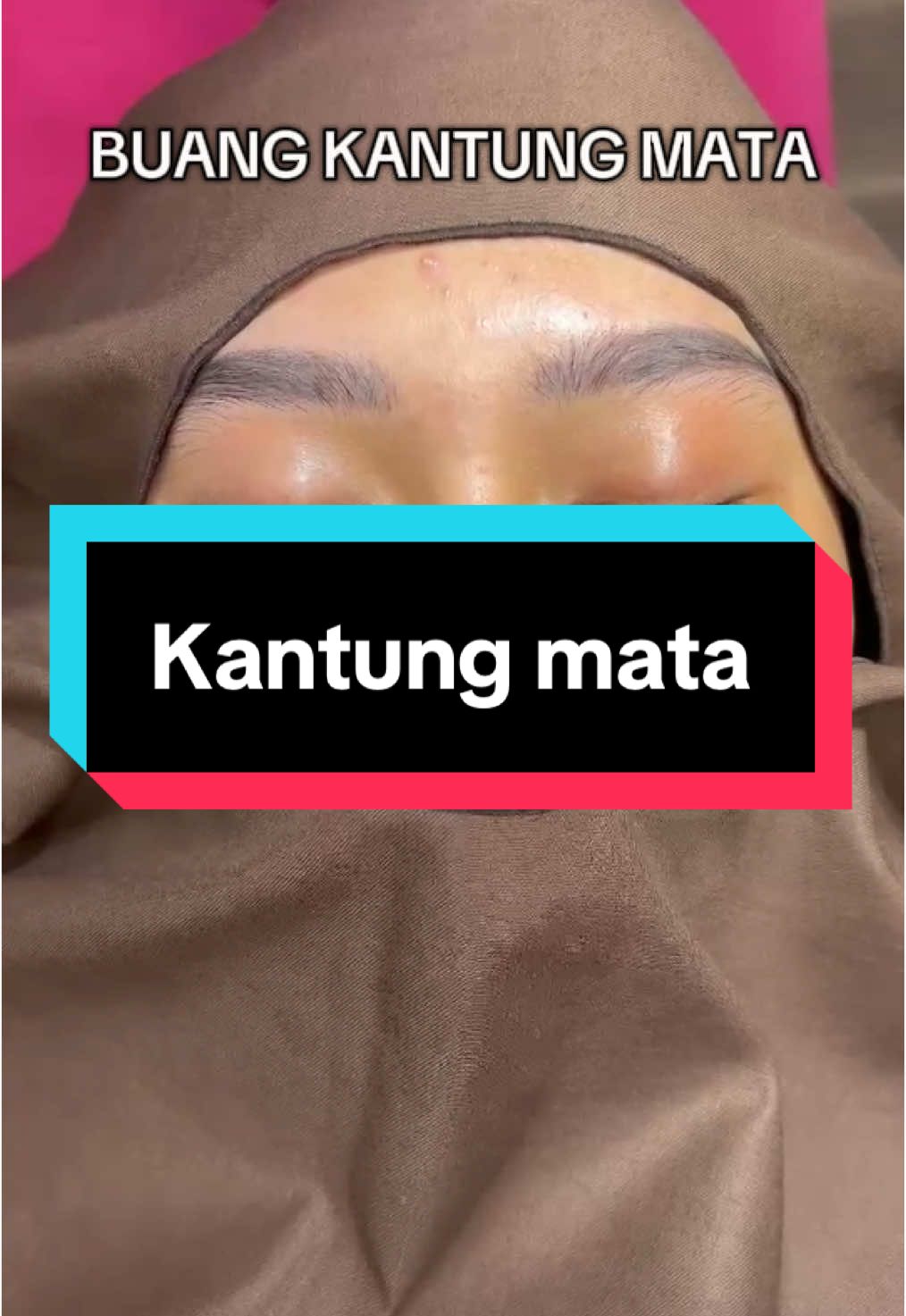 Buang kantung mata dulu biar muda terus #eyebag #eyebagremoval #eyebags 
