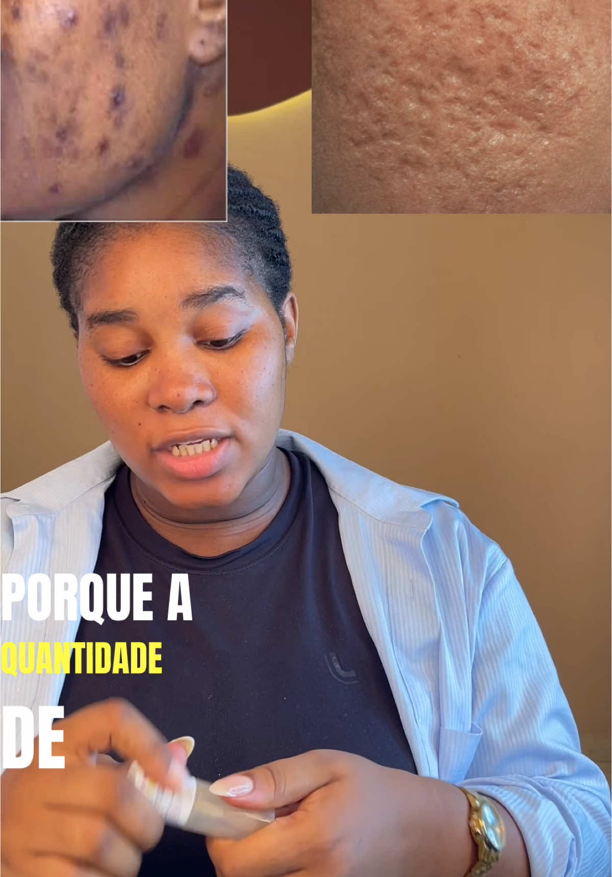 Entre mancha e Cicatriz existe uma diferença enorme, e é melhor você se livrar da mancha antes que ela vire uma cicatriz #skincarecoreana #acnetreatment #cuidadoscomapele #skincareroutine #keauty #pelessemmanchas 