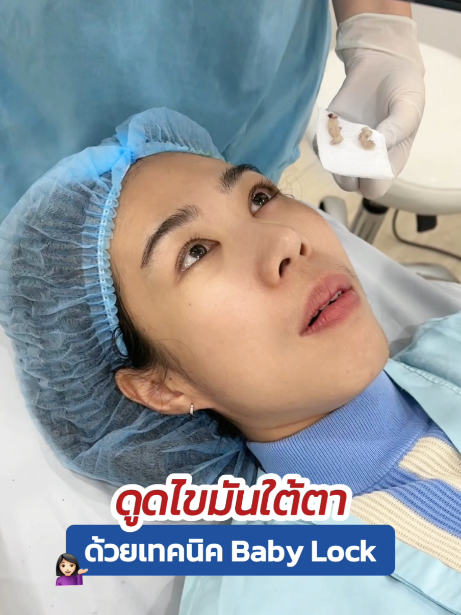 ดูดไขมัน #ถุงใต้ตา 📍 ด้วยเทคนิค #babylock #กำจัดถุงใต้ตา #ตัดถุงใต้ตา #skyclinic #สกายคลินิก #ทีมแพทย์หมอสกาย #ทําตาที่ไหนดี #ศัลยกรรมตา #รีวิวบิวตี้ 