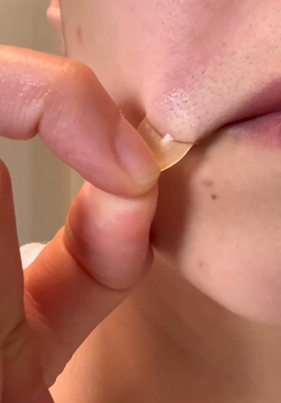 Nothing like a satisfying pimple patch reveal ft. our Acne Dot 🤩 #pimplepatch #gunkreveal #pimplepatchreveal 