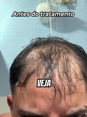 Queda de Cabelo tem tratamento!