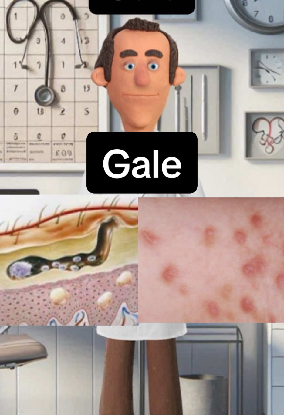 Gale  #gale #medecine #vulgarisation #ifsi #etudianteinfirmière #etudiantmedecine 