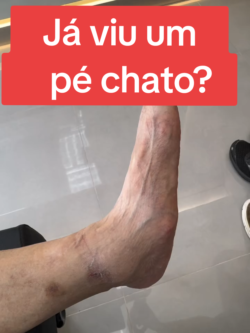 PÉ CHATO: O QUE É E COMO TRATAR? 🦶⚡ Você já percebeu que a sola do seu pé encosta completamente no chão ao andar ou ficar em pé? Isso pode ser um sinal de pé chato, também chamado de pé plano! 👣 🔍 O que é o Pé Chato? O pé chato acontece quando a curvatura natural do pé (arco plantar) não se desenvolve corretamente. Isso pode causar dores, fadiga e até problemas na postura! 😖 ⚠ Principais Causas: ✅ Genética – Algumas pessoas já nascem com essa característica. ✅ Fraqueza muscular – Falta de força nos pés e tornozelos pode agravar o problema. ✅ Uso de calçados inadequados – Sapatos sem suporte podem influenciar a pisada. ✅ Lesões ou doenças – Como artrite e obesidade, que afetam a estrutura dos pés. ❌ Sinais e Sintomas: 🚨 Dor nos pés, tornozelos ou joelhos 🚨 Sensação de cansaço ao caminhar 🚨 Dificuldade em correr ou manter equilíbrio 🚨 Desgaste irregular dos calçados ✅ Tratamento e Melhores Exercícios: 🔹 Fisioterapia para fortalecimento dos músculos do pé e tornozelo. 🔹 Exercícios como caminhada na areia e elevação dos calcanhares. 🔹 Palmilhas ortopédicas para suporte do arco plantar. 🔹 Alongamentos para melhorar a mobilidade e reduzir dores. Se você tem pé chato, a boa notícia é que existem várias formas de melhorar sua qualidade de vida! 💪👣 🔥 Quer saber mais? Salva esse vídeo e compartilha com quem precisa! 🔎 Melhores palavras-chave para pesquisa no TikTok: ✔ Pé chato sintomas ✔ Como corrigir pé chato ✔ Exercícios para pé chato ✔ Fisioterapia para pé chato ✔ Melhor palmilha para pé chato ✔ Pé plano dor no pé 🚀 Hashtags para viralizar: #PéChato #Fisioterapia #SaúdeDosPés #DorNoPé #ExercíciosParaPéChato #PéPlano #PosturaCorreta #FortalecimentoMuscular #DicasDeSaúde #FisioTips