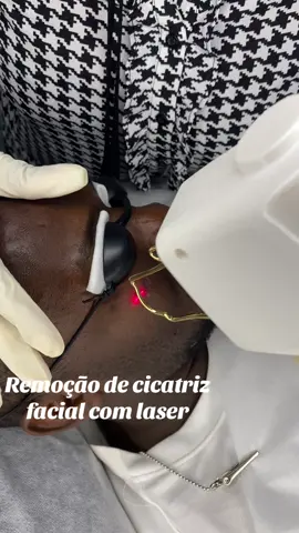 Remoção de cicatriz facial com laser #estriasembarazo #estriasvermelhas #manchas #lasermedicoesthetique #angola🇦🇴 #portugal🇵🇹 #acnes #eliminacaodeestrias #mocambiquetiktok🇲🇿 
