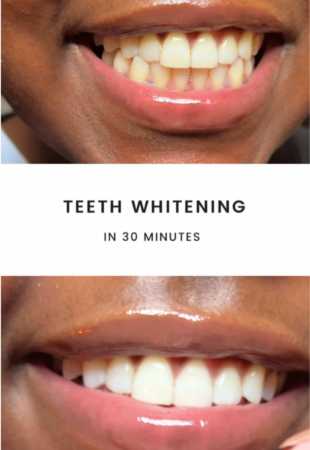 Gonna try do the whole 14 day treatment and give you results 😌 @Whites Beaconsfield  #teethwhitening #whitesbeaconsfieldstrips #whitesbeaconsfield #teethwhiteninghack #fyp 