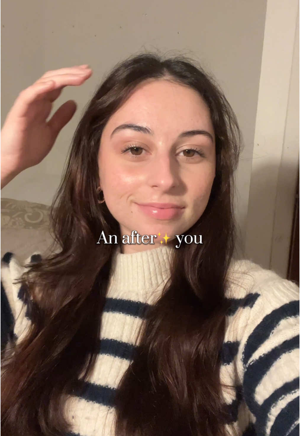 Roaccutane journey 💗 my skin after 5 months of treatment #roaccutanejourney #accutane #accutanejourney #acnescars #acneproneskin #skintok inspo : @e r i n 