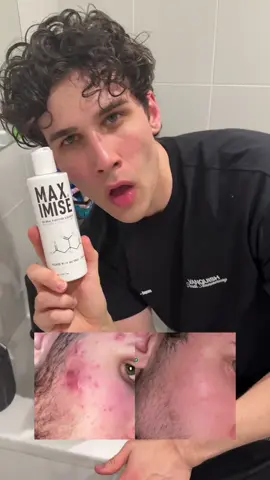 Some people wanted my routine so here it is, simple but effective 👊 Maximise available on TikTok shop and my website 🙌 #acne #fyp #skincare 