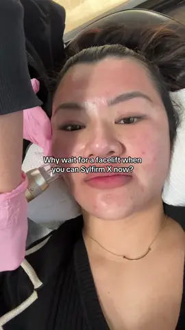 It’s always me against gravity 😂 Sylfirm X is RF microneedling (the power combo you need for anti-aging). Treatment by @EverGlow Aesthetics 🩶 #tustinca #ocmedspa #rfmicroneedling #microneedlingtherapy #radiofrequencyfacial #antiagingskincare #orangecountyca 