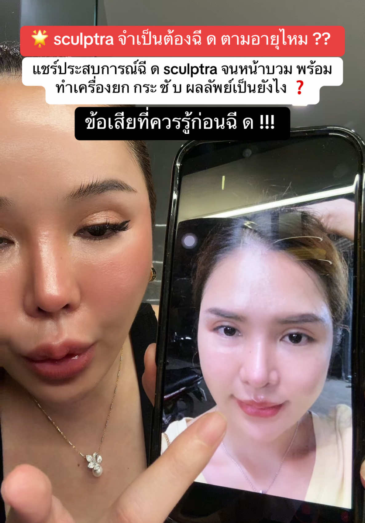 ตอบกลับ @Kevinwang แชร์ประสบการณ์ฉี ด sculptra 4 ขวด  แต่ไม่เจอปัญหาใดใดในเรื่องของเป็นก้อน เพราะเว้นระยะของการเติม ไม่จำเป็นต้องเติมเดือนละครั้ง ตามที่หมอบอกว่าให้ ห า ร ด้วยอายุ  การฉีด sculptra ปัจจุบันยังไม่มีตัวยาสลายดังนั้น ควรเลือกฉี ด กับแพทย์ที่มีความชำนาญ สิ่งสำคัญคือไม่ควรเติมเยอะจนเกินไปและสิ่งต่างๆที่เข้ามาในวงการความงามปัจจุบันมีเยอะมากบางตัวไม่ได้เหมาะสมกับเราไม่ต้องสรรหาทำจ้า #รี#รีวิวฉ่ำพู#พูดไปเรื่อยอ#บอกแล้วว่าสวยรี#รีวิวบิวตี้ม#หมวยฟ้าศัลย์หาทําเร#เรื่องความสวยน#หน้าใสsc#sculptraต#เตือนภัยอ#รอบรู้เรื่องความงามท#เทรนความสวยั#ศัลยกรรมศั#ศัลย์หาทําอ#บอกต่อรีวิวี#รีวิวบิวตี้ในtiktokต#เตือนภัยความงาม