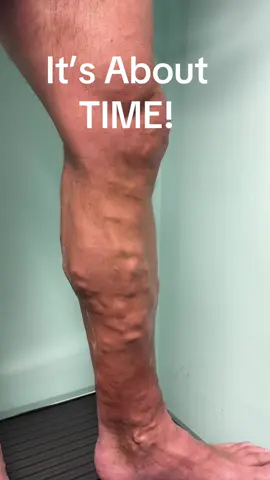 Venous HYPERTENSION causes SKIN DAMAGE. The longer you wait the worse it becomes and harder to treat. #varicoseveins #lipodermatosclerosis #venousdisease #venousstasisulcer #dermatologie #DOGE #physicianassistant #nurse #DrBonavita #DrSos #legpain #chandler #EVLT #podiatry #ABVLM #Venaseal #dermatology #legday #SuperBowl #venousinsufficiency #sclerotherapy #varithena 