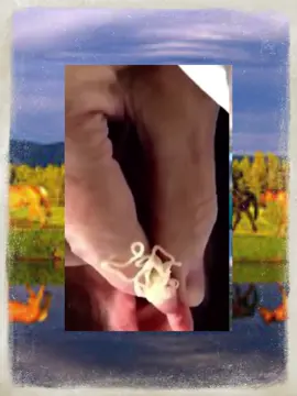 #squeeze#squeezezuk#pimple#pimplepop#acne#skincare#blackhead#satisfyingvideos#fyp