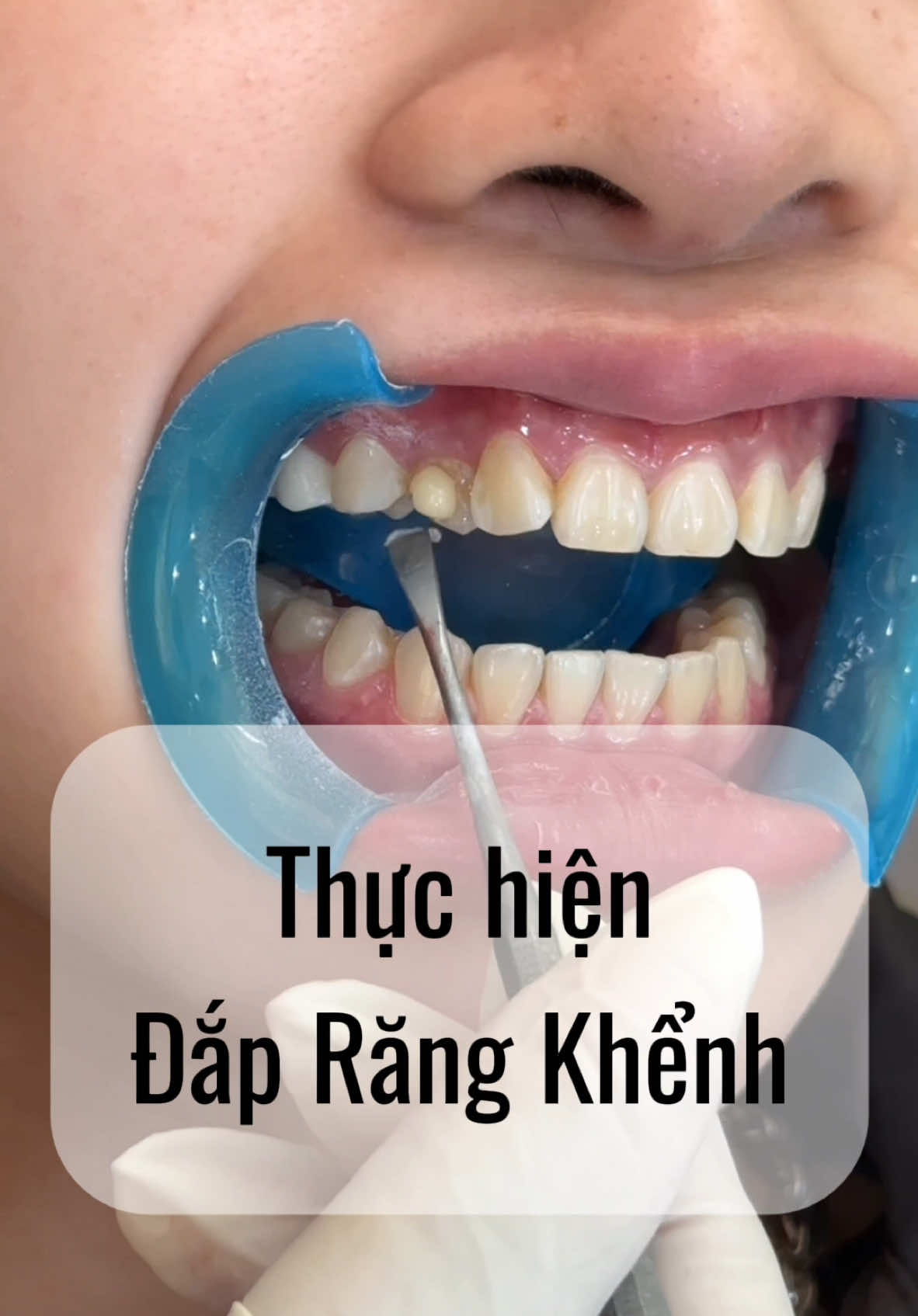 Đắp lại dáng Răng Khểnh sau 2 năm ☺️#đắp_răng_khểnh #răng_khểnh #khểnh #yfp #tiktokviral #thinhhanhxuhuong #xuhướngthịnhhành #🦷 #hottrend #viral 