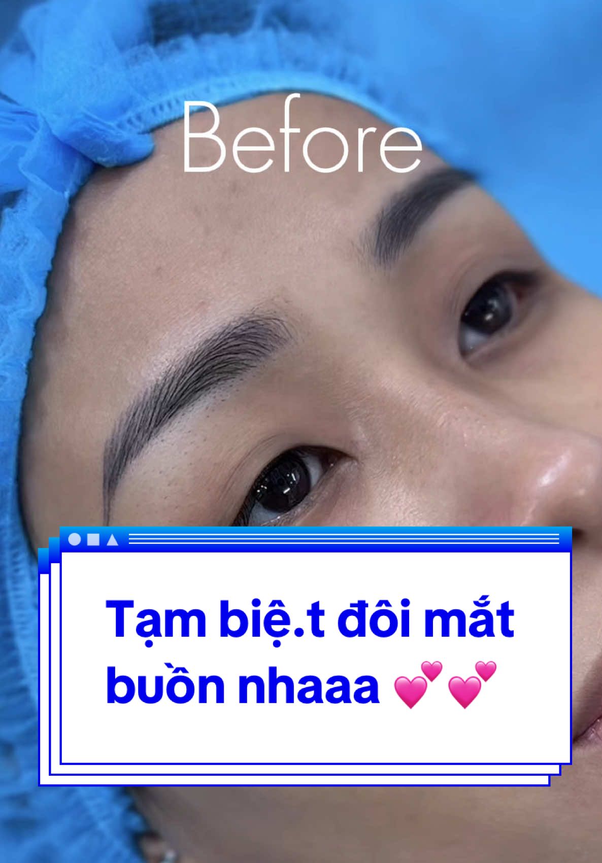 Tạm biệ.t đôi mắt  buồn nhaaa 💕💕#Tuyết_Diamond #videoviral #xuhuong #Mí_form_tự_nhiên ###mở_góc_mắt_trong_ngoài 