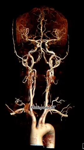 #CapCut CT Scan mạch máu não #CTSCAN #RadiographerDT #SISCANTHO 