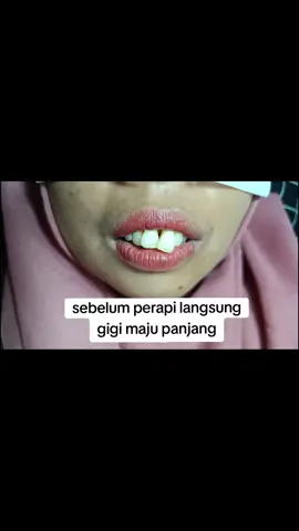 Perapi gigi langsung tanpa behel, 1× pengerjaan pertemuan langsung rapi rata, awal gigi panjang dan maju hasil gigi langsung mundur, yg penting korbankan gigi asli dgn cr dikikir 